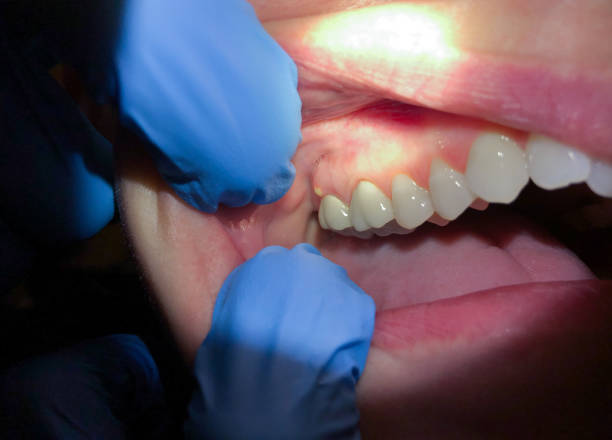 Best Emergency Dental Filling Replacement  in Four Bridges, OH