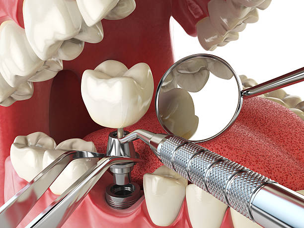 Best Broken Tooth Emergency  in Four Bridges, OH